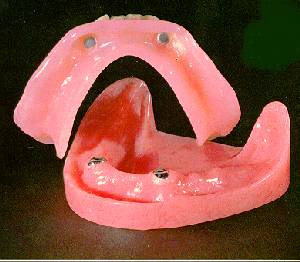 overdenture