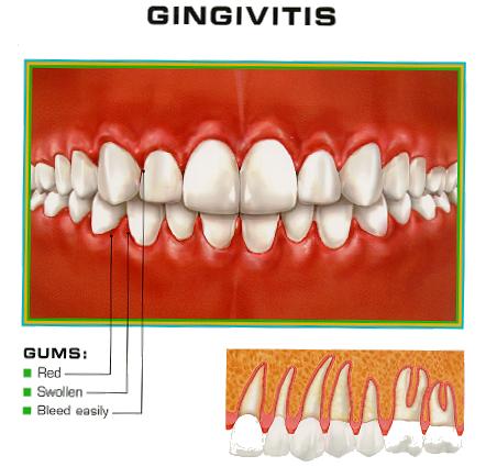 gingivitis Enfermedad periodental 