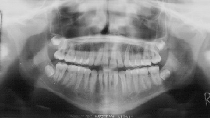 Dental X Rays